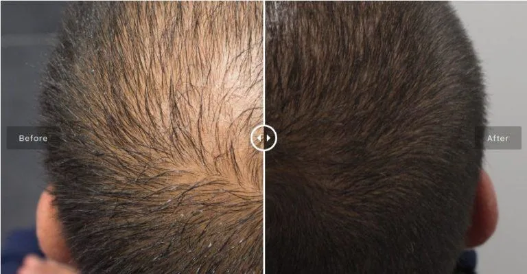 Regenerate Scalp Damagepromotes The Growth of Thicker, Stronger Hair for Dermica® Hairzon - Stylo Mesotherapy/ Dermal Cegaba